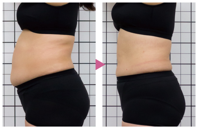 ナール517 リポスティムフィットビフォーアフター